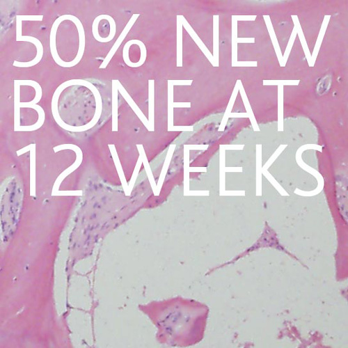 50-new-bone-at-12-weeks-500x500